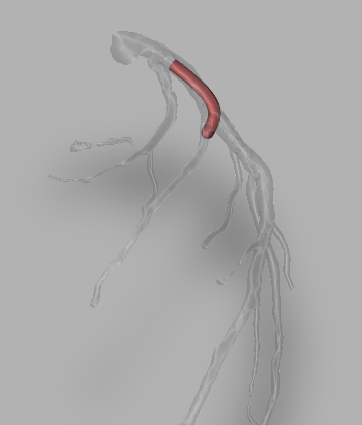 20191208-151448_ProximalLAD^APCRA.jpg