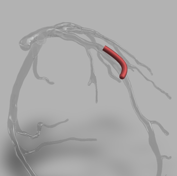 20191208-171340_MidLAD^RAOCRA.jpg