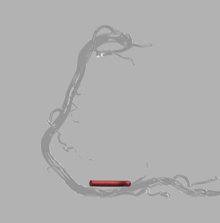 20191208-183521_DistalRCA^LAO.jpg